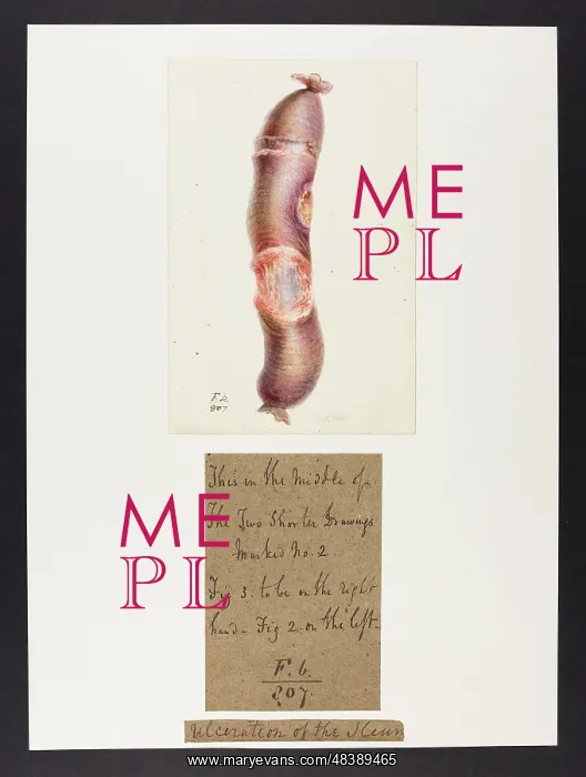 : Ulceration of the Ileum : Ulceration of the Ileum