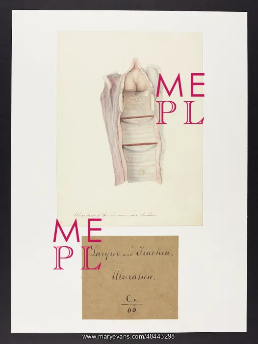 : Ulceration of the Larynx and Trachea : Ulceration of the Larynx and Trachea