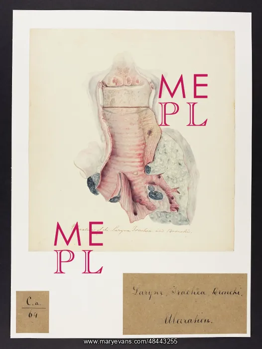 : Ulceration of the Larynx, Trachea and Bronchi : Ulceration of the Larynx, Trachea and Bronchi