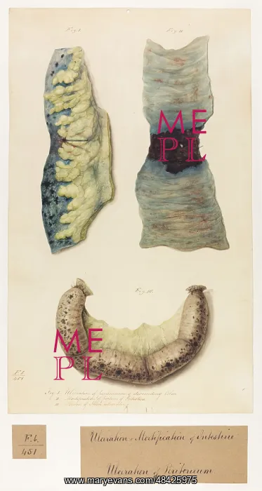 : Ulceration and mortification of intestine : Ulceration and mortification of intestine