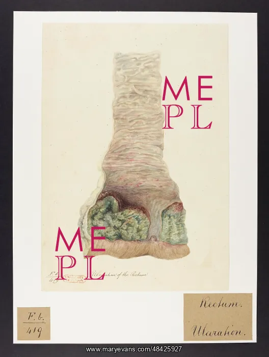 : Ulceration of the Rectum : Ulceration of the Rectum