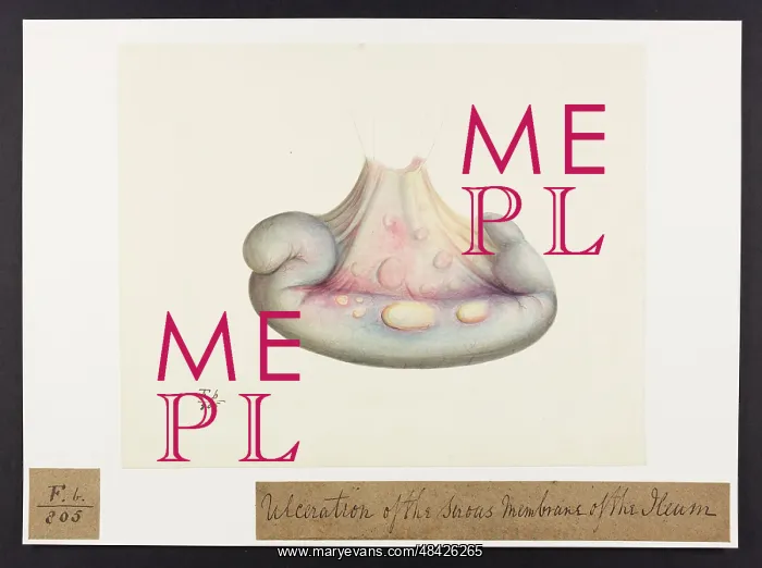 : Ulceration of the Serous Membrane of the Ileum : Ulceration of the Serous Membrane of the Ileum