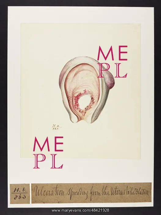 : Ulceration Spreading from Uterus to Bladder : Ulceration Spreading from Uterus to Bladder