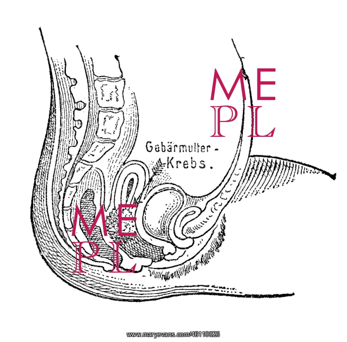  : Uterine cancer, 1902