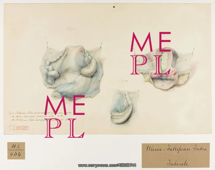 : Uterus and Fallopian Tubes: Tubercles : Uterus and Fallopian Tubes: Tubercles