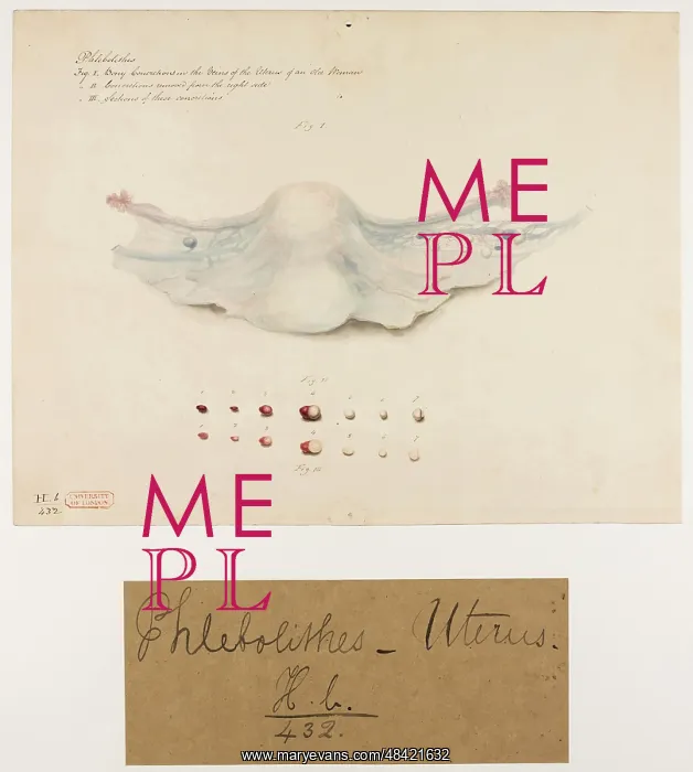 : Uterus: Phlebolithes : Uterus: Phlebolithes