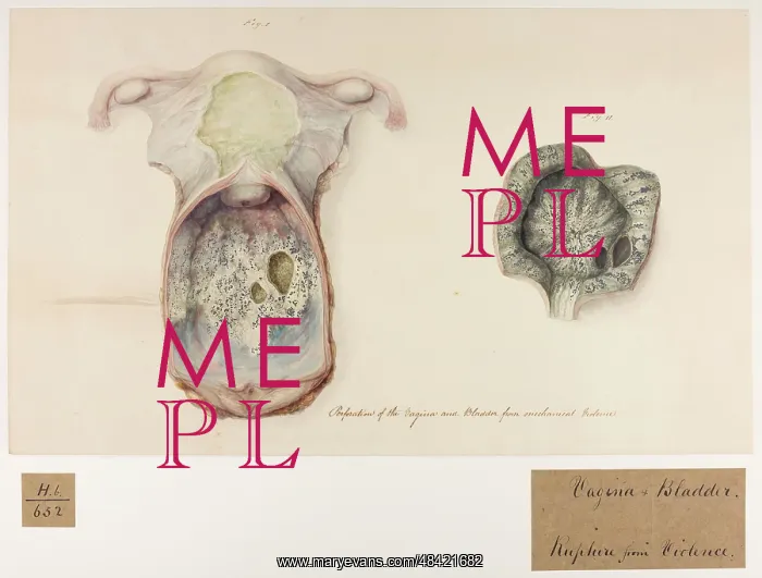 : Vagina and Bladder: Perforation from Mechanical Violence : Vagina and Bladder: Perforation from Mechanical Violence