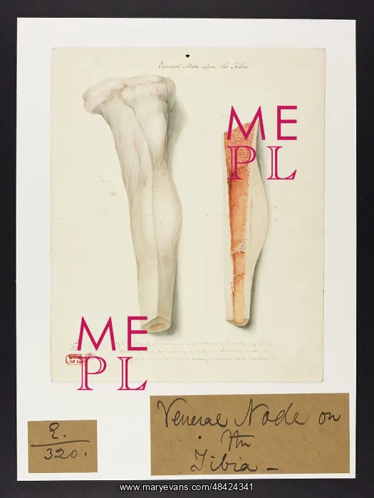 : Venereal Node upon the Tibia : Venereal Node upon the Tibia