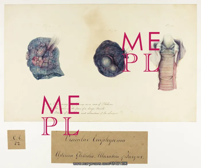: Vesicular Emphysema, Oedema glottides, Ulceration of Larynx : Vesicular Emphysema, Oedema glottides, Ulceration of Larynx