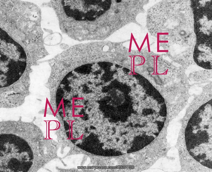 : White Blood Cells in Leukemia : White Blood Cells in Leukemia