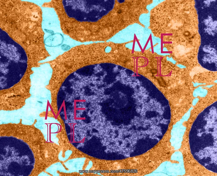: White Blood Cells in Leukemia (TEM) : White Blood Cells in Leukemia (TEM)