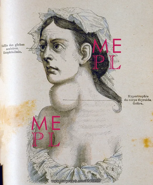 : Woman with goitre, and enlargement of the thyroid : Woman with goitre, and enlargement of the thyroid