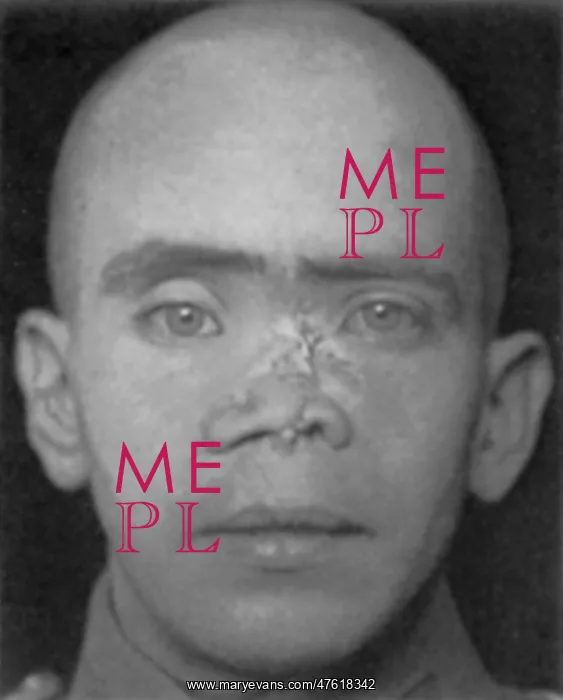: WWI Veteran Needing Reconstructive Surgery : WWI Veteran Needing Reconstructive Surgery