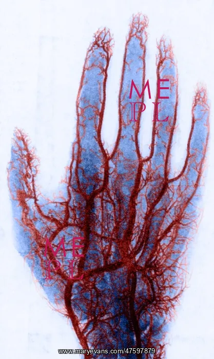 : X-ray of Blood Vessels : X-ray of Blood Vessels
