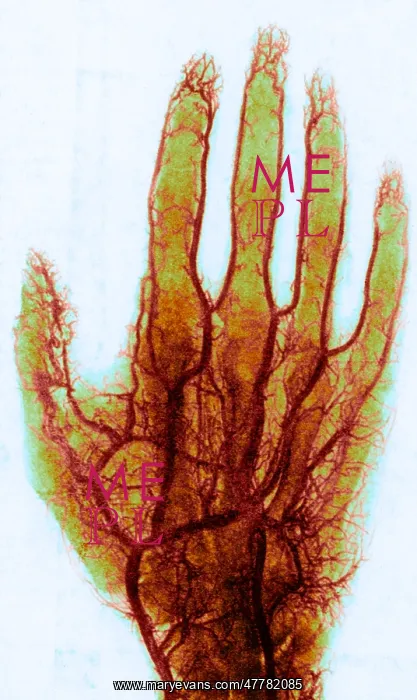 : X-ray of Blood Vessels : X-ray of Blood Vessels