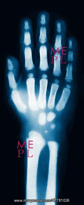 : X-ray of Child's Hand, 1896 : X-ray of Child's Hand, 1896
