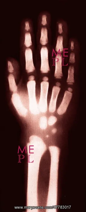 : X-ray of Child's Hand, 1896 : X-ray of Child's Hand, 1896