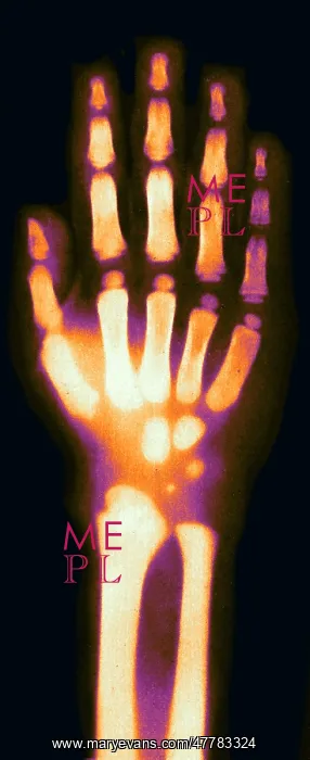 : X-ray of Child's Hand, 1896 : X-ray of Child's Hand, 1896