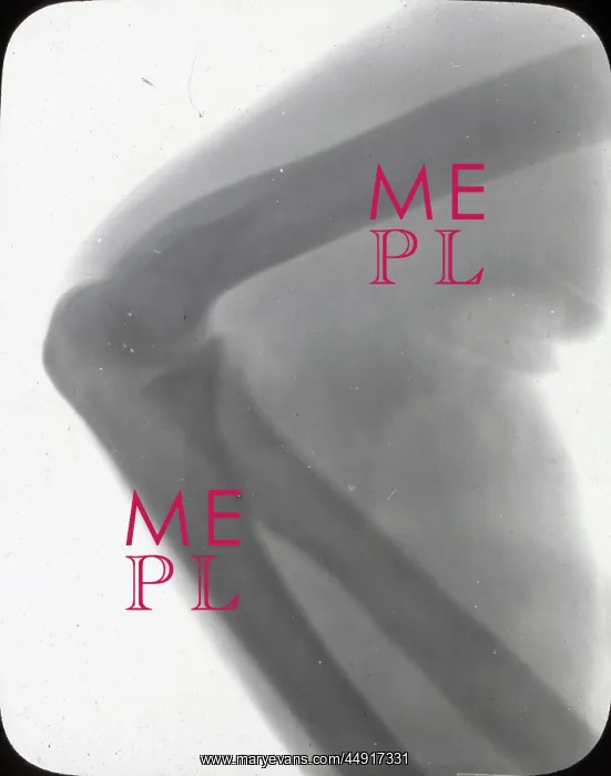 : X-Ray - Elbow Joint : X-Ray - Elbow Joint