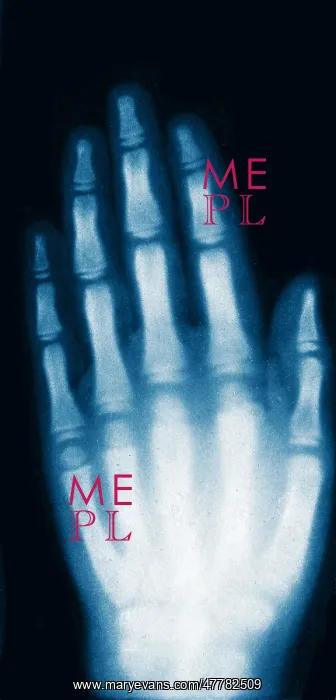 : X-ray of Girl's Hand, 1896 : X-ray of Girl's Hand, 1896