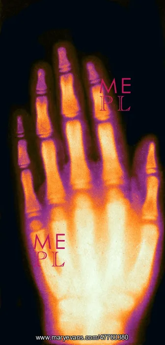 : X-ray of Girl's Hand, 1896 : X-ray of Girl's Hand, 1896