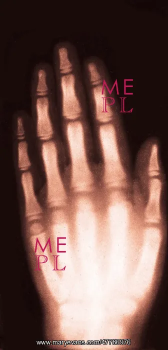: X-ray of Girl's Hand, 1896 : X-ray of Girl's Hand, 1896