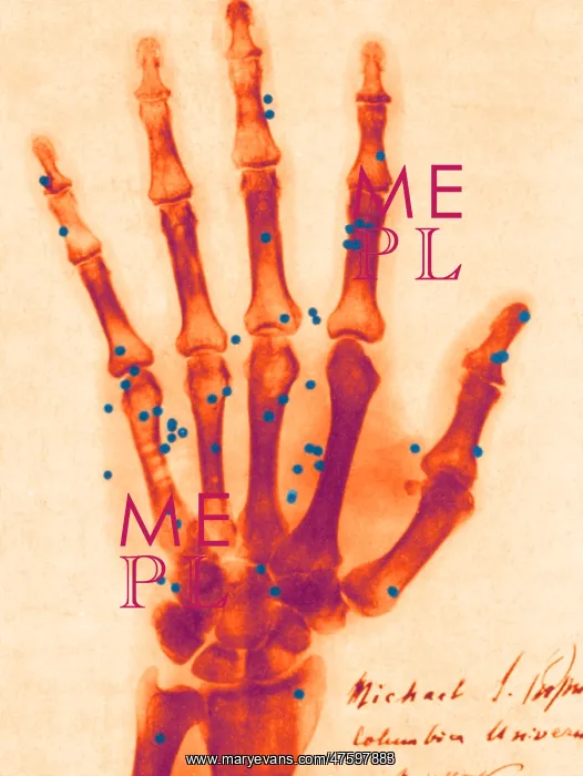 : X-ray of Gunshot in the Hand : X-ray of Gunshot in the Hand