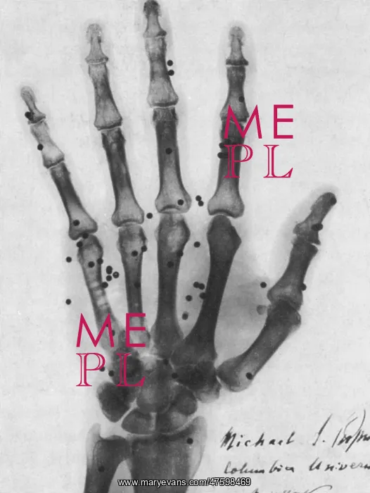 : X-ray of Gunshot in the Hand : X-ray of Gunshot in the Hand