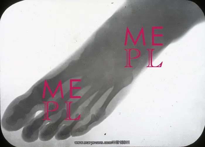 : X-Ray - Human Foot : X-Ray - Human Foot