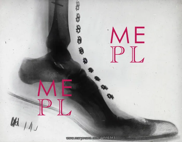 : X-Ray - Human Foot : X-Ray - Human Foot