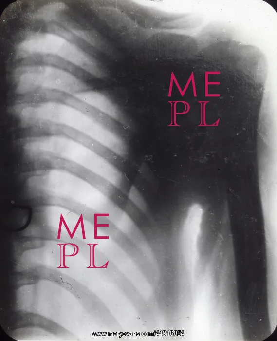 : X-Ray - Human Male Chest : X-Ray - Human Male Chest