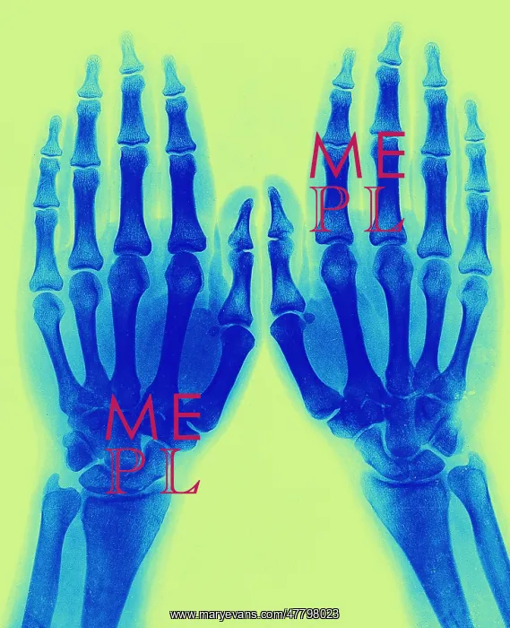 : X-Ray of Two Normal Hands, 1896 : X-Ray of Two Normal Hands, 1896