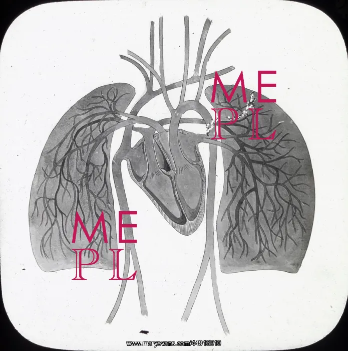 : X-Ray - Pulmonary Circulation : X-Ray - Pulmonary Circulation