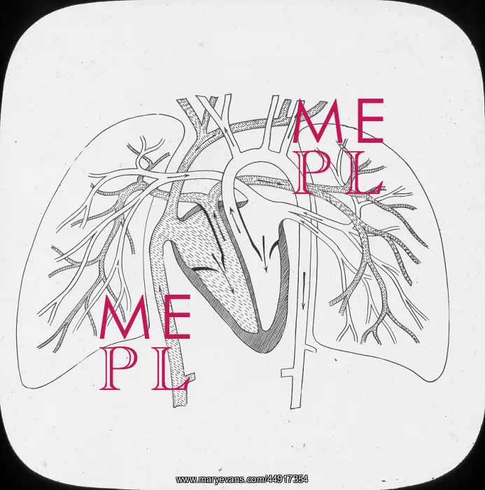 : X-Ray - Pulmonary Circulation : X-Ray - Pulmonary Circulation