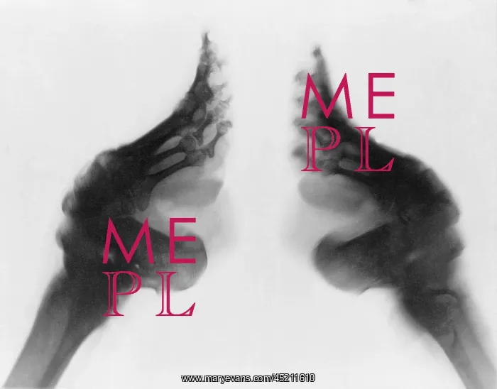 : X-ray of a woman's bound feet, China. Ca. ? : X-ray of a woman's bound feet, China. Ca. ?