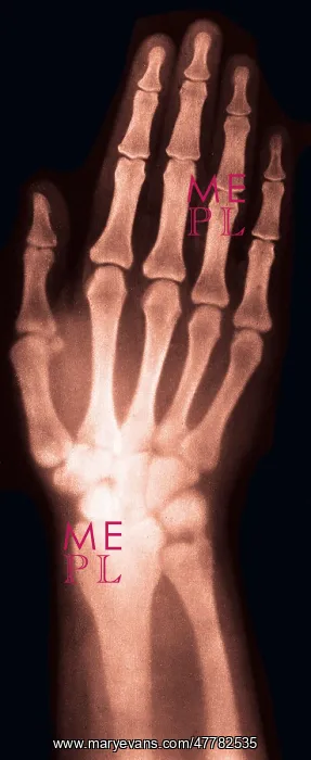 : X-ray of Woman's Hand, 1896 : X-ray of Woman's Hand, 1896