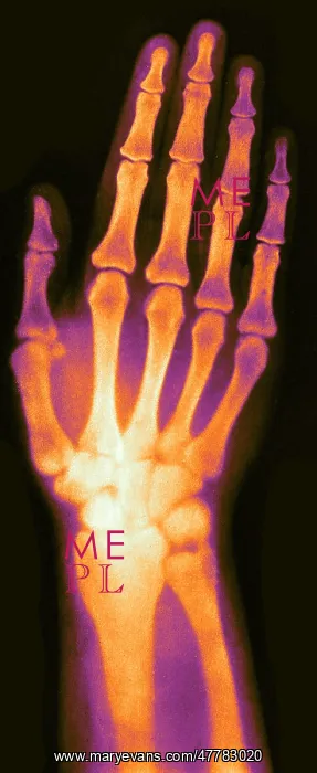 : X-ray of Woman's Hand, 1896 : X-ray of Woman's Hand, 1896