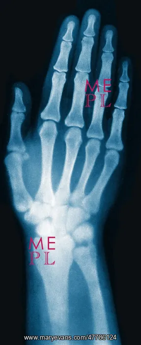 : X-ray of Woman's Hand, 1896 : X-ray of Woman's Hand, 1896