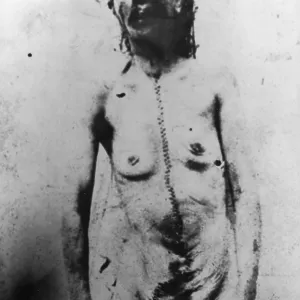 BODY OF VICTIM, EDDOWES BODY OF VICTIM, EDDOWES