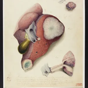 Cancerous Tumours in the Liver Cancerous Tumours in the Liver