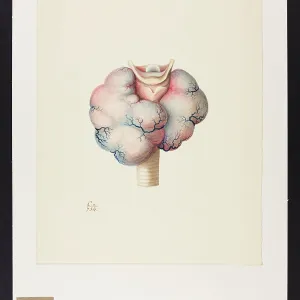 Enlarged Thyroid Gland Enlarged Thyroid Gland