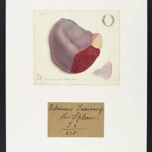 Fibrinous Tumour of the Spleen Fibrinous Tumour of the Spleen