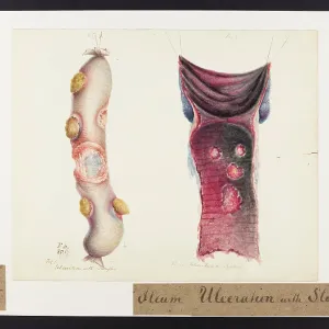 Ileum: Ulceration and Sloughs Ileum: Ulceration and Sloughs