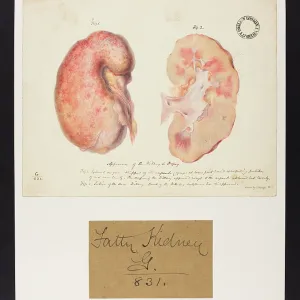 Kidney in Dropsy Kidney in Dropsy