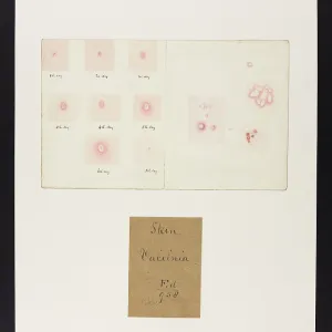 Skin : Vaccinia Skin : Vaccinia