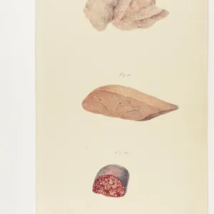 Tubercles in the Lungs, Liver and Spleen Tubercles in the Lungs, Liver and Spleen
