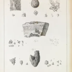 Urinary stones Urinary stones