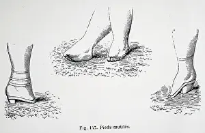 Consequences: 19th century consequences of foot binding in China