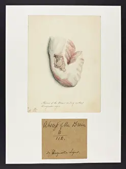 Brain: Abscess of the Brain