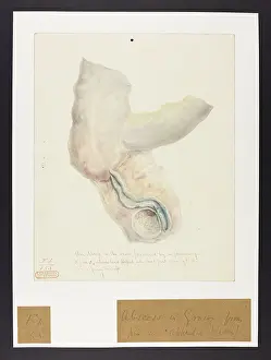 Passed: Abscess in the Groin